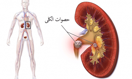 في غياب اتفاقيات بين مصالح الضمان الاجتماعي والخواص: مرضى يدفعون 40 مليونا للتخلص من حصى الكلى
