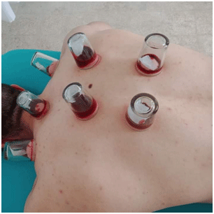 زيادة لافتة في الإقبال عليها خلال الجائحة: تحذيـرات من تسبـب الحجامــة في انتقــال الأمــراض