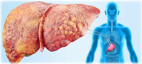 أصبح يصيب الأطفال في الآونة الأخيرة : الإفراط في تناول السكريات والعصائر يؤدي لتشحم الكبد